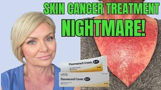 THE UGLY TRUTH ABOUT SKIN CANCER: My Fluorouracil Treatment Journey