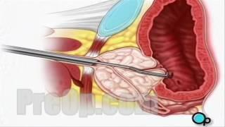 TURP Transurethral Resection Prostate Surgery, patient education series