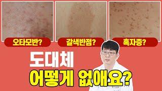 오타모반/갈색반점/흑자증 치료방법 파헤치기! - ‍‍피부과전문의추천 모반 레이저는