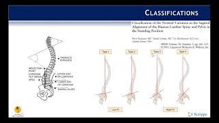 Classification: Adult Spinal Deformity