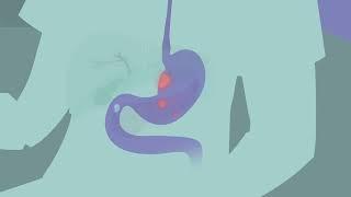 What are the Signs & Symptoms of Stomach Cancer?