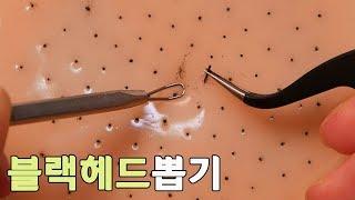 【 SUB】 Handmade black_head removal toy