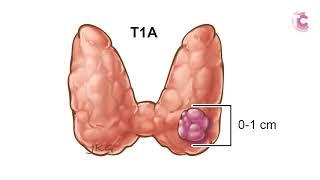 Thyroid Cancer: what is my prognosis?