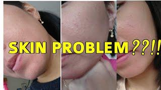 #bisdak #kproducts  SKIN PROBLEM STORY + Unboxing Korean Skin Care Products