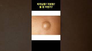 피지낭종?지방종?-구별법_예스항외과