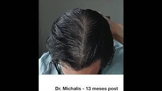 3213 Grafts FUE Hair Transplant Cyprus without shaving recipient area - Dr. Michalis Georgiou