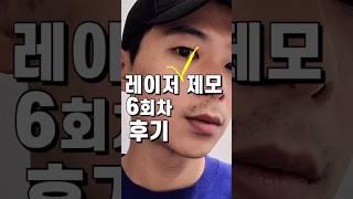 수염제모 레이저 후기_수염제모전후비교_30대남자 자기관리