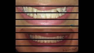 Braces: Way to achieve beautiful & healthy smile!!