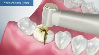 DENTAL CROWNS & BRIDGES 1