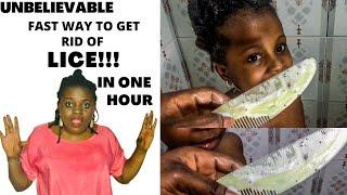 How to Get Rid of Head Lice in 1 Hour !!! (Very Simple Technique) #nigerianyoutuber #portharcourt