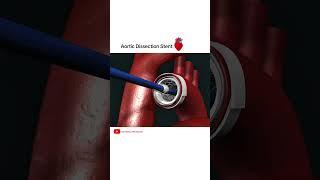 Aortic dissection Stent grafting #cardiology #shorts