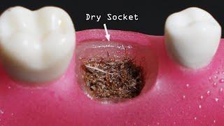 Dry Socket- The Worst Pain After Tooth Extraction Causes and Treatment.