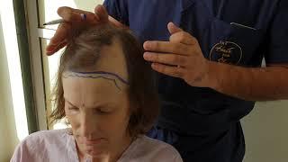 International Transgender patient Hair Transplant at the hair and Shape Clinic Malad West Mumbai