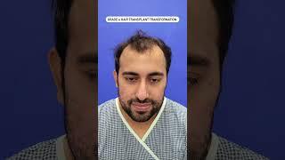 Best Hair Transplant in Delhi | Best Results of Hair Transplant