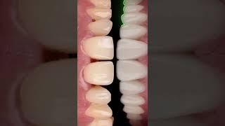 Digital Smile Design with Veneers!  #shorts #dentaltech #veneers