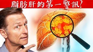 有脂肪肝的第一警訊?修復脂肪肝,自然療法,柏格醫生 Dr Berg