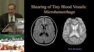 MRI of Truamatic Brain Injury by Dr.  David J  Mikulis