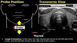 Thyroid Ultrasound Probe Positioning | Transducer Placement, Scanning Technique USG