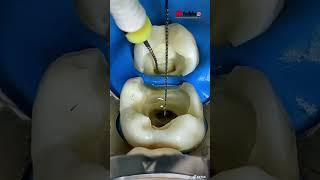 “Limas para hacer un  tratamiento de conducto(ENDODONCIA)”