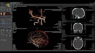 Vitrea Demonstrations  |  Circle of Willis