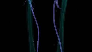 acute thromboemboli to left lower extremity