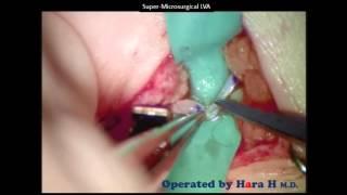 Lymphedema surgery in Japan -LVA under local anaesthesia - Makoto Mihara M.D. and Hisako Hara M.D.