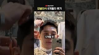 비절개 모발이식 6개월 후기..미쳤다!!