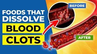 TOP 7 FOODS that Dissolve BLOOD CLOTS