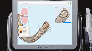 iTero® Scanner Tutorial: TimeLapse Technology