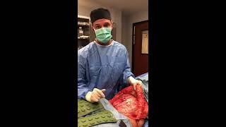 Rectus Diastasis Repair During Tummy Tuck