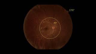 ultra wide field fundus camera