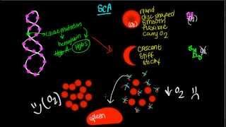 Pathophysiology of Sickle Cell Anemia