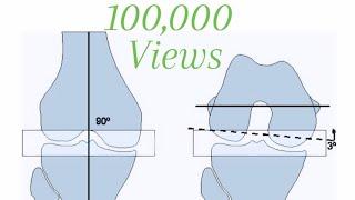 Total Knee Replacement Step by Step