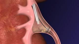 CoAx 15mm Stone Control Catheter - PCNL Antegrade Approach