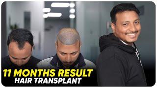 Hair Transplant in Mysore | Best Results & Cost of Hair Transplant in Mysore