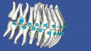 Excelerated Orthodontics in Oklahoma City - Sky Ortho