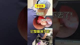 一分鐘了解微創無線射頻鼻塞手術