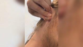 Popping huge blackheads and Pimple Popping - Best Pimple Popping Videos 59