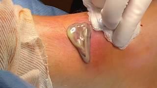 Draining pus from an abscess on an infected ankle