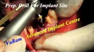 Implants in PeriApical Case - Dr.Sakthe Murukan