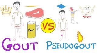 Gout vs. Pseudogout - MSU vs. CPPD disease - Rheumatology Series