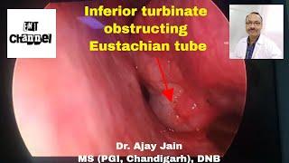 how turbinate reduction surgery improved Eustachian tube dysfunction and helped to avoid ear surgery