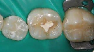 Лечение кариеса. Tooth decay treatment.