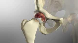 Osteoarthritits Repair via Direct Anterior Hip Replacement