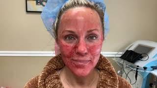 WHAT IS PRP? - PRP FACELIFT - MICRONEEDLING - DR. TANVEER JANJUA - NEW JERSEY