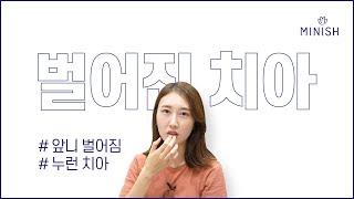 벌어진 앞니 교정 어떻게 치료할까요?｜미니쉬치과병원