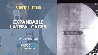 Lateral Expandable Cages - Jeffrey S. Roh, MD , MBA