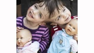 Special Feature TV: Conjoined twins share brain!