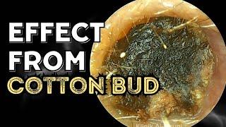 DISASTROUS Effect From Cotton Bud Use