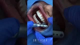 Shiny smiles with Unilaser- Bonding veneers